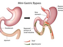 Mini gastric by-pass