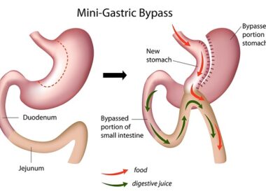 Mini gastric by-pass