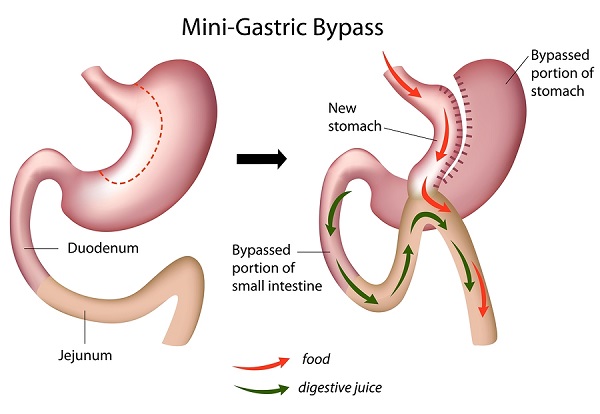 Mini gastric by-pass