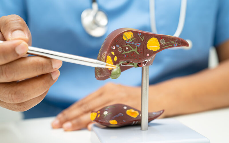 Νέο υποψήφιο φάρμακο αντιστρέφει τη μεταβολική ηπατική νόσο και την ίνωση, δείχνουν προκλινικά δεδομένα